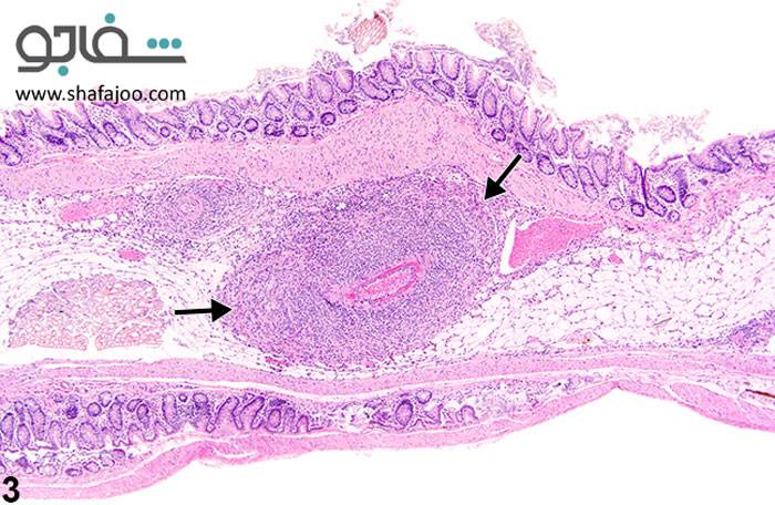 پلی‌ آرتریت‌ گرهی (پری‌ آرتریت‌؛ آنژئیت‌ نکروزان‌) - polyarteritis nodosa