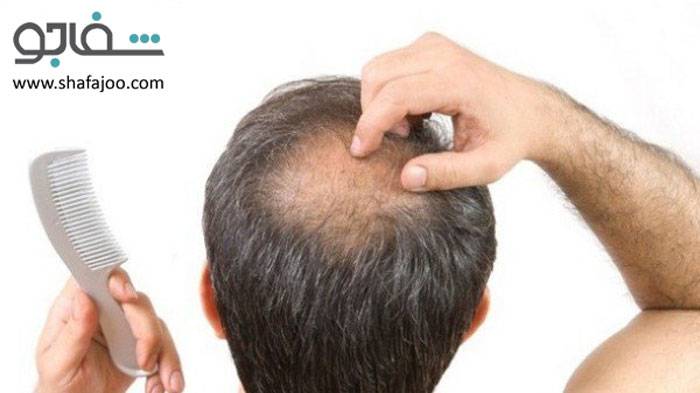 طاسی منطقهای (آلوپسی آرهآتا) - alopecia areata