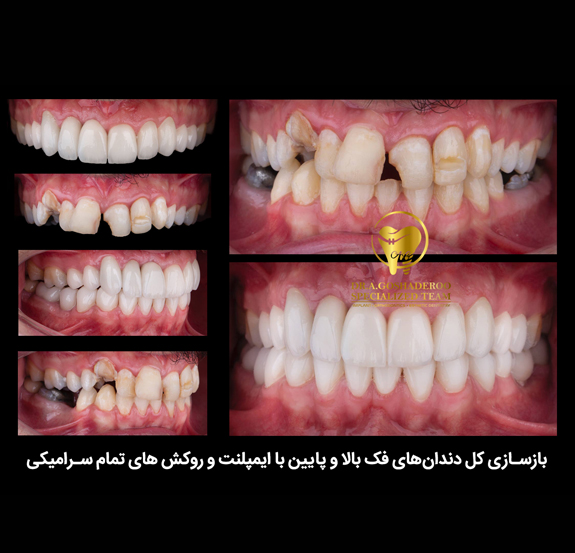 ایمپلنت فوری دندان: راهحلی سریع و مؤثر برای بازگرداندن لبخند