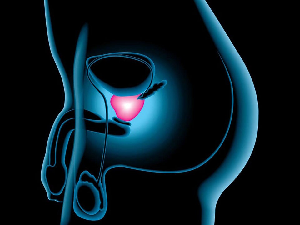 پروستاتیت (التهاب پروستات) چیست و درمان آن چگونه است؟