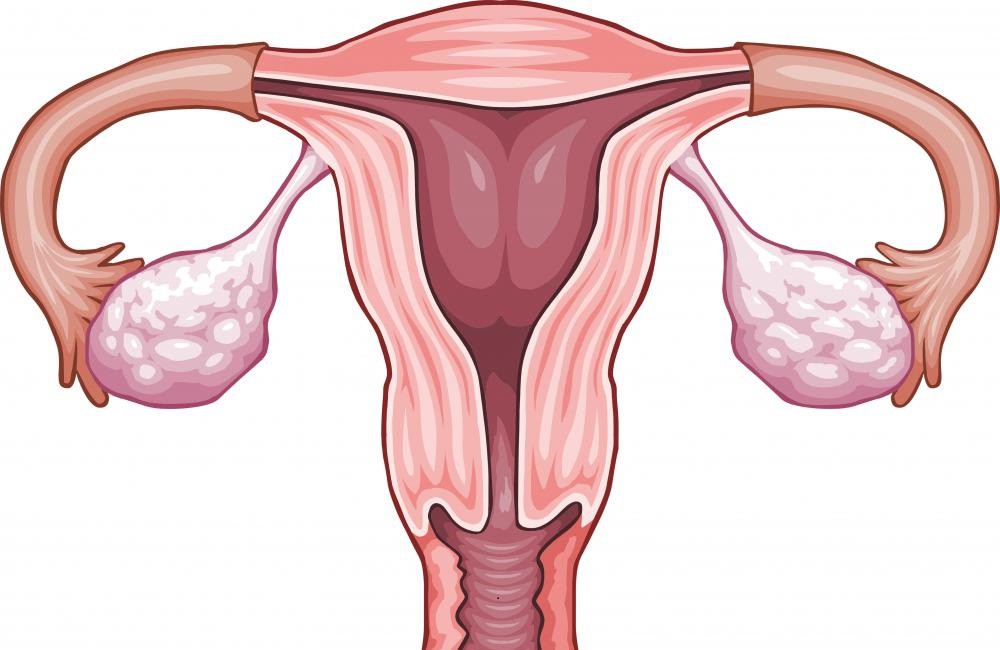 سرطان تخمدان: علل، علائم، تشخیص و درمان سرطان تخمدان