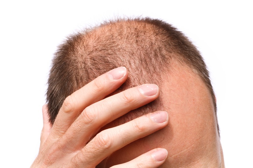 ریزش مو: علل، علائم، تشخیص و درمان ریزش مو