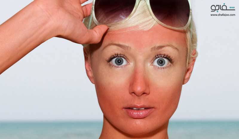 روغن نارگیل و درمان  آفتاب سوختگی پوست
