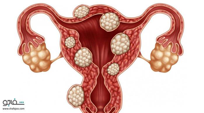 تومورهای‌ فیبرویید رحم‌ - Fibroid tumors of the uterus