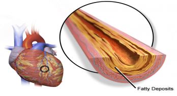 بیماری عروق کرونر قلب(علائم و درمان)