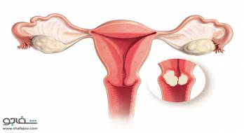 سرطان‌ رحم‌ - uterine cancer