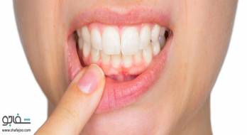 دهان خندقی‌(ژنژیویت زخمی نکروزدهنده،بیماری ونسان) - trench mouth
