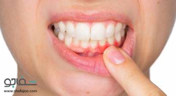 پریودنتیت‌ (التهاب‌ لثه‌) - periodontitis