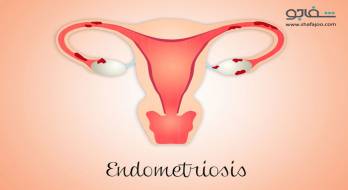 آندومتریوز - Endometriosis