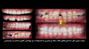 ایمپلنت فوری دندان: راهحلی سریع و مؤثر برای بازگرداندن لبخند ایمپلنت فوری دندان: راهحلی سریع و مؤثر برای بازگرداندن لبخند