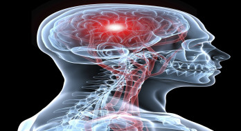 آنچه باید در مورد علائم سکته مغزی بدانیم