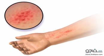 واکنش‌ پوستی‌ آلرژیک‌ به‌ عفونت‌ پوست‌ - واکنش‌ پوستی‌ آلرژیک‌ به‌ عفونت‌ پوست‌