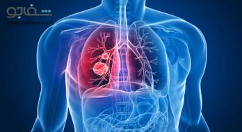 بیماری‌ انسداد ریوی‌ مزمن‌ - chronic obstructive pulmonary disease