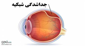 جداشدگی‌ شبکیه‌ - retinal detachment