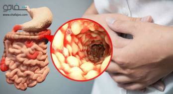 بیماری کرون - Crohn's disease