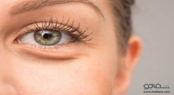 چه عواملی سبب ایجاد تیرگی زیر چشمان شما می شود؟