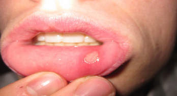 آفت دهان: علائم، علل، پیشگیری و درمان آفت دهان