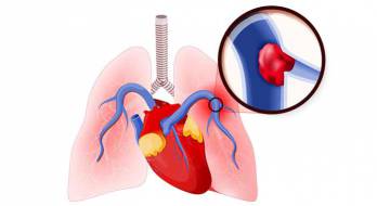 علائم بیماری آمبولی ریه را بشناسید - وب سایت پزشکی سلامتی شفاجو