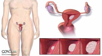 سرطان‌ مهبل‌ یا وولو - cancer of vagina or vulva