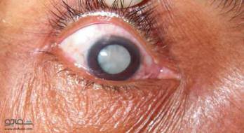 علل، علائم، تشخیص و درمان آب مروارید چشم