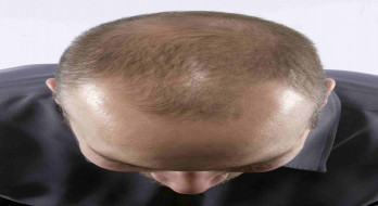 ریزش مو در مردان: پیشگیری و درمان ریزش مو