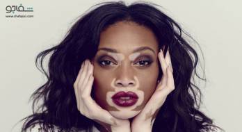 برجس‌ (ویتیلیگو) - vitiligo