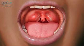 گلودرد استرپتوکوکی - strep throat‌