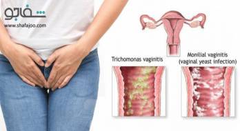 واژینیت‌ تریکومونایی‌ (تریکومونیاز) - vaginitis trichomonal