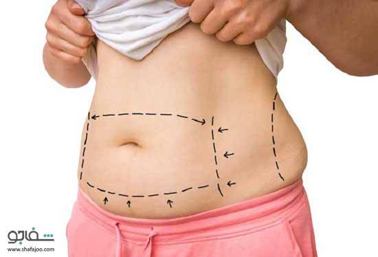 چگونه چاقی را درمان کنیم؟ جراحی چاقی شکم و پهلو (تامی تاک یا آبدومینوپلاستی)