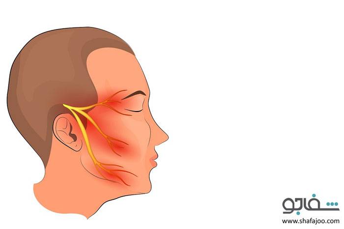 درد عصب‌ سه‌ قلو (نورالژی‌ تری‌ ژمینال‌) - trigeminal neuralgia