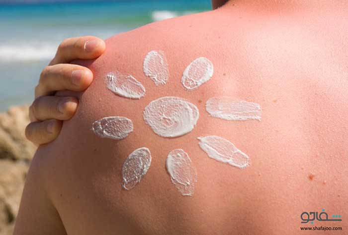 آنچه باید درباره تاول های ناشی از آفتاب سوختگی بدانید